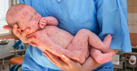 Brotes de sarampión | Señalan la importancia de la vacunación para evitar la propagación de la enfermedad 