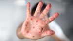 Paraguay confirmó el primer caso de sarampión