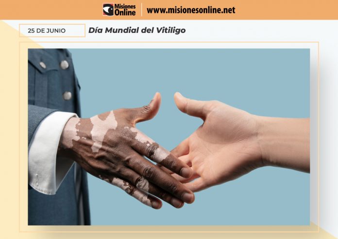 vitiligo