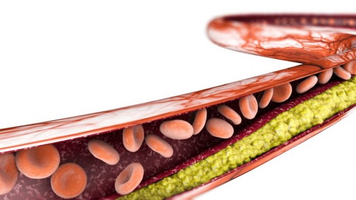 Cholesterol formation, fat, artery, vein, heart