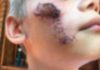 niño de 7 años atacado por un rottweiler