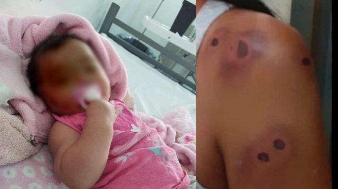 beba de 5 meses recibió un balazo de goma en la cabeza