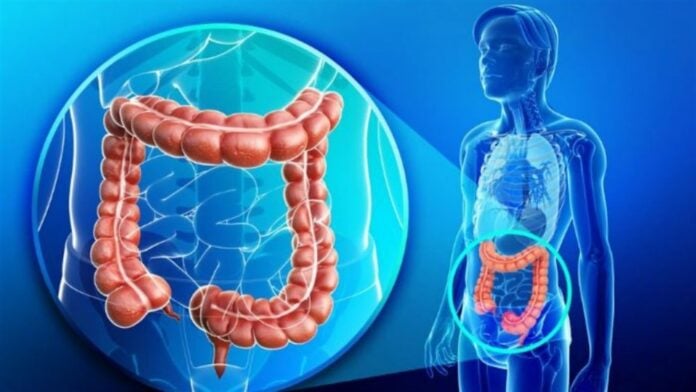 cáncer de colon