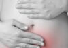 endometriosis