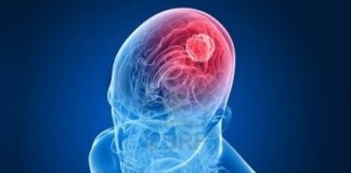 riesgo de cáncer de cabeza y cuello