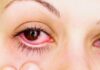 casos de conjuntivitis