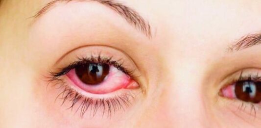 casos de conjuntivitis