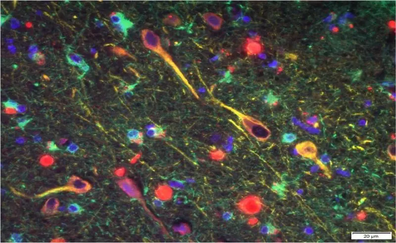 Gingipolin de gingivalis (rojo) entre las neuronas en el cerebro de un paciente con Alzheimer (Cortexyme)
