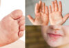 síndrome manos-pies-boca