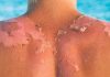 Cuidado de la piel en verano