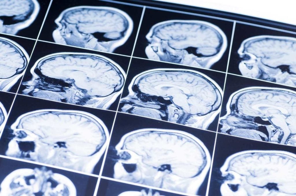 Un estudio advierte que factores ambientales y sociales pueden acelerar hasta nueve veces el envejecimiento cerebral